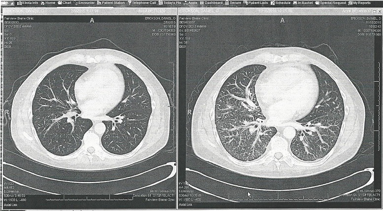 Undifferentiated cancer